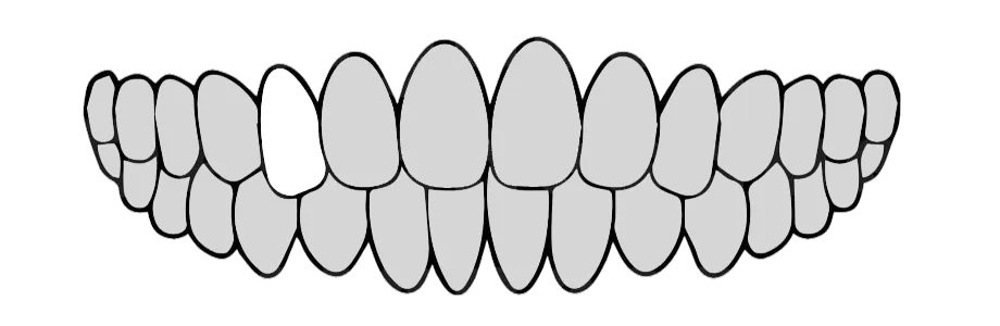 セラミック治療1本