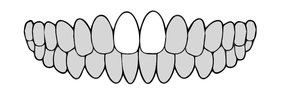 セラミック治療2本