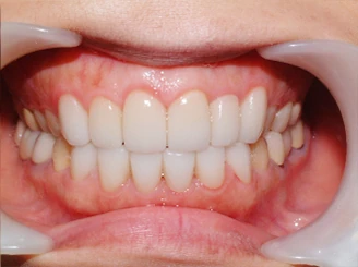 セラミック矯正6本after