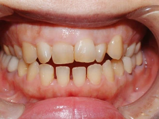 セラミック矯正6本before