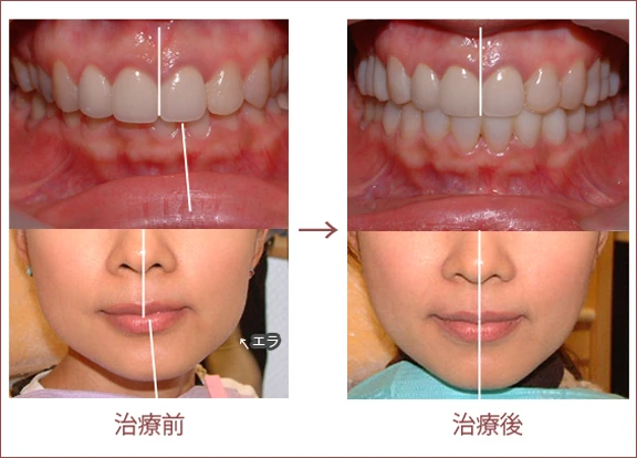 シーラ咬合システム
